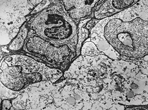 F,49y. | hemangioblastoma - brain F,49y. | hemangioblastoma - brain